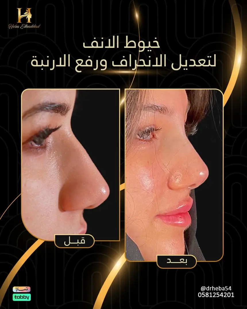 خيوط الأنف — تعديل الانحراف ورفع الأرنبة