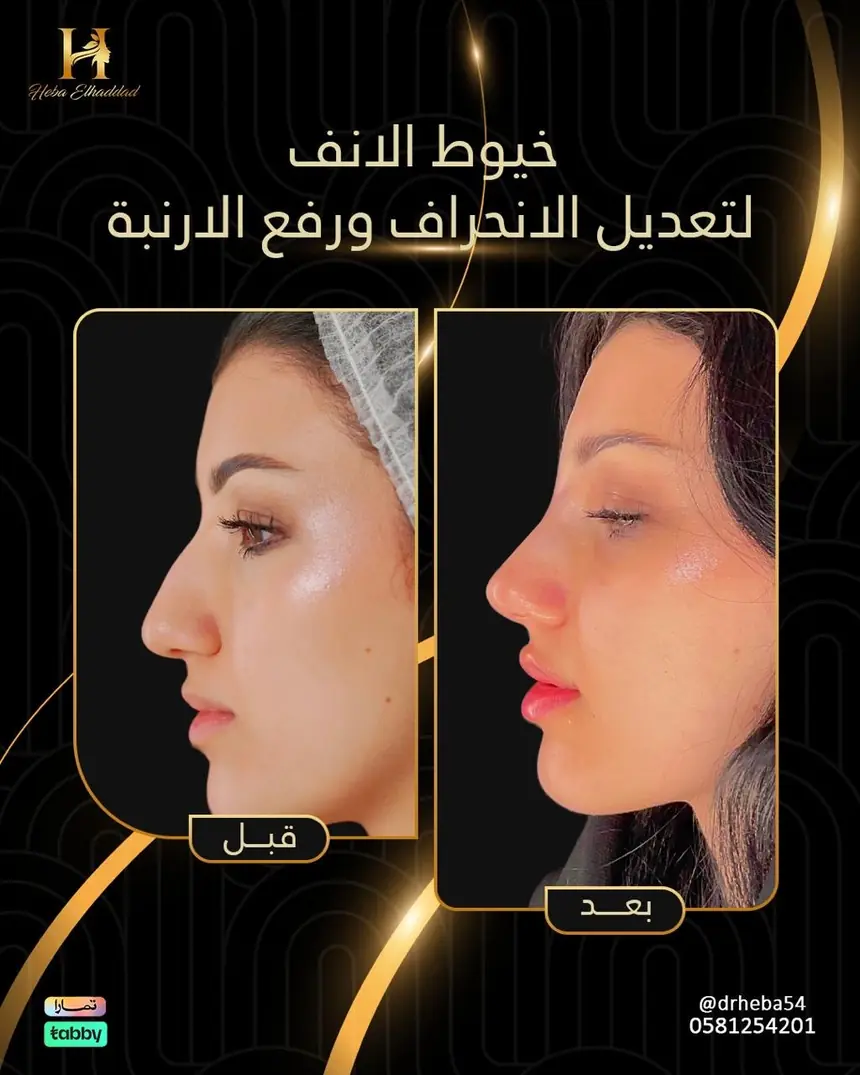 خيوط الأنف — تعديل الانحراف ورفع الأرنبة