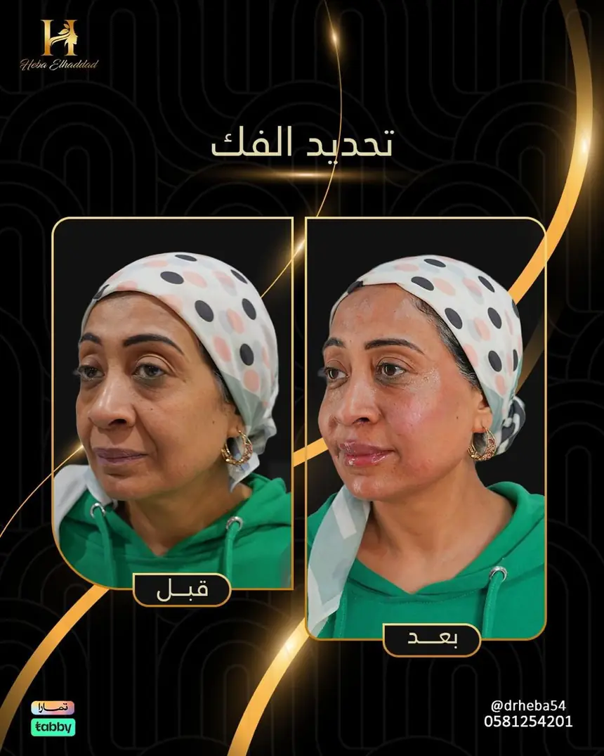 تحديد خط الفك