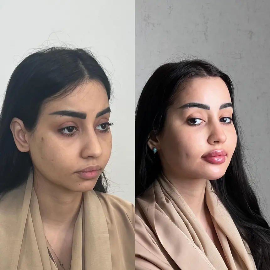 فيلر الشفاه ونحت الملامح