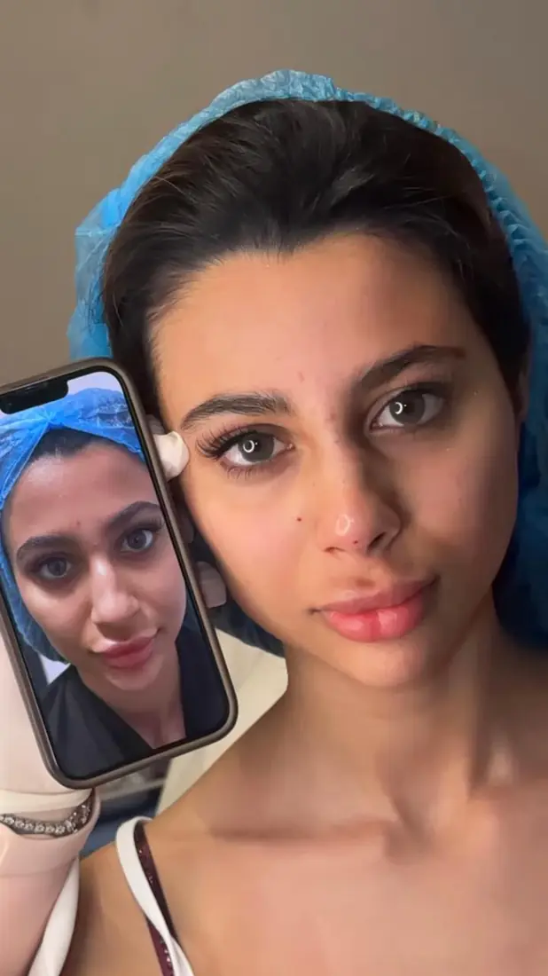 فيلر الشفاه — في نفس الزيارة